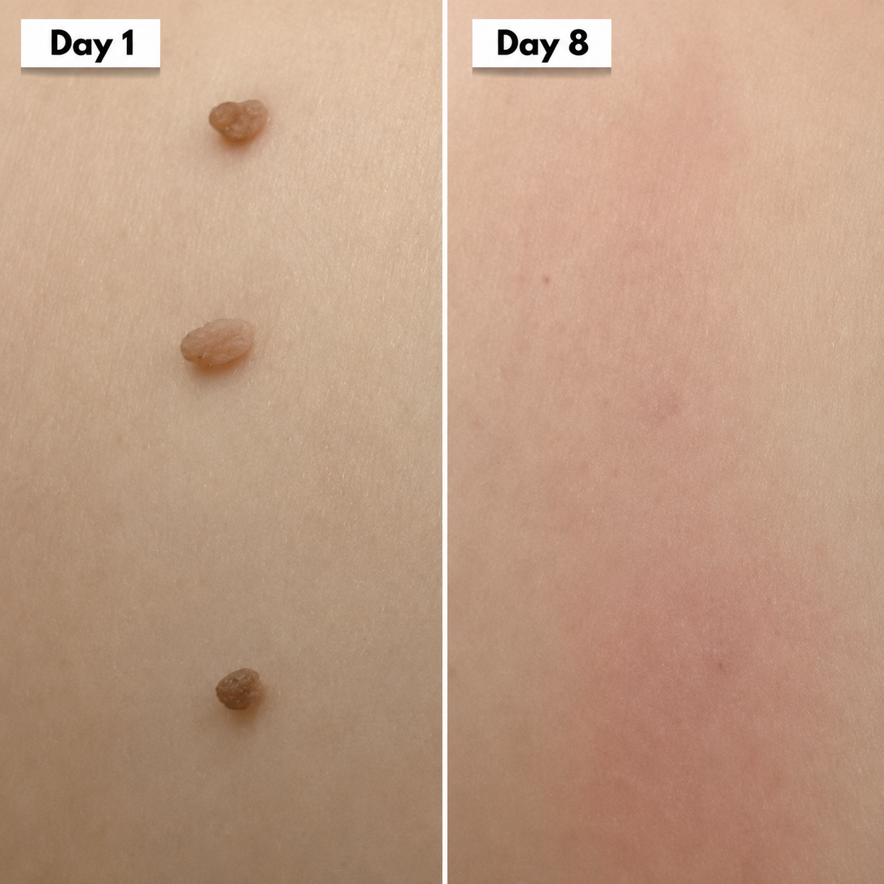 Vantyx Skin Tag Remover Kit