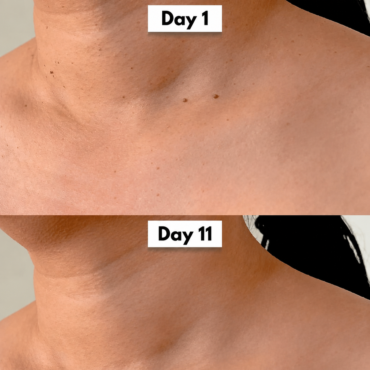 Vantyx Skin Tag Remover Kit