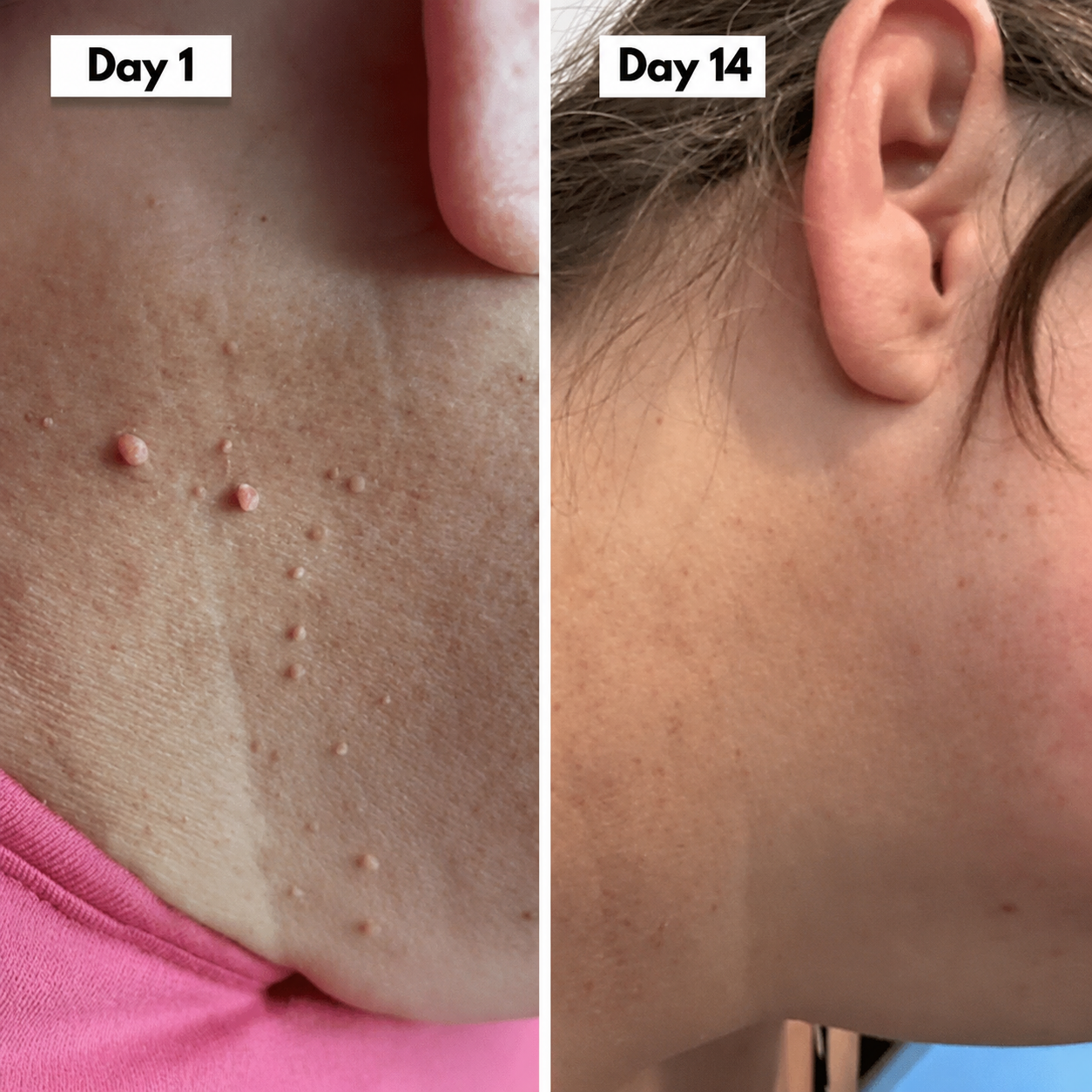 Vantyx Skin Tag Remover Kit